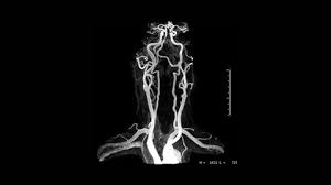 MR Angiography 