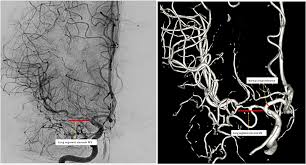 Digital Subtraction Angiography