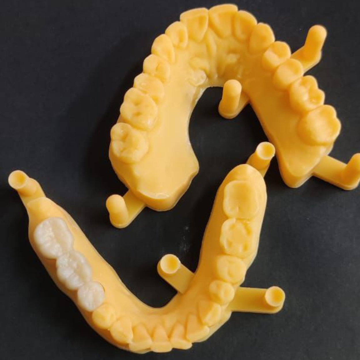 Complete denture set for full-mouth reconstruction Complete denture set for full-mouth reconstruction