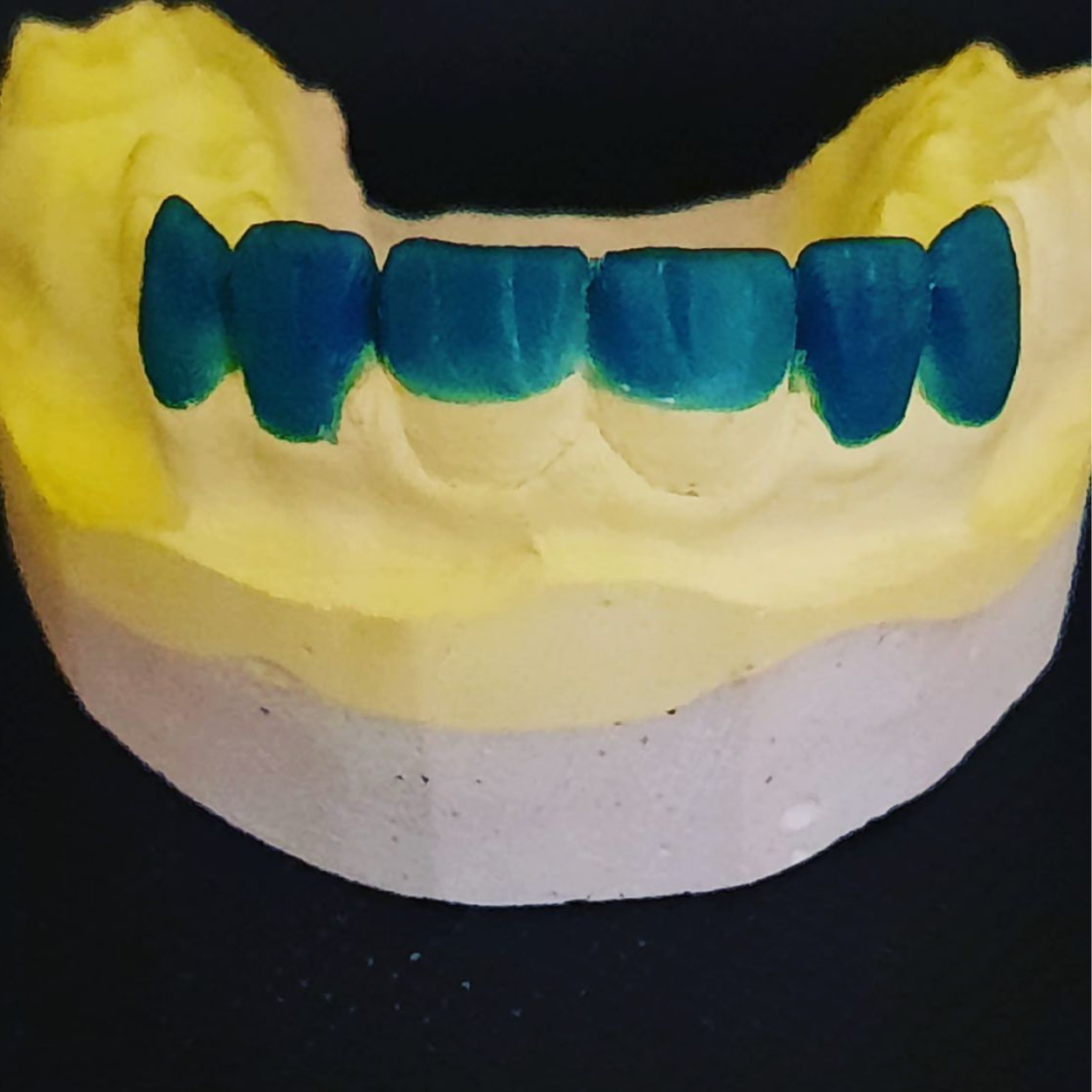 Custom Abutment