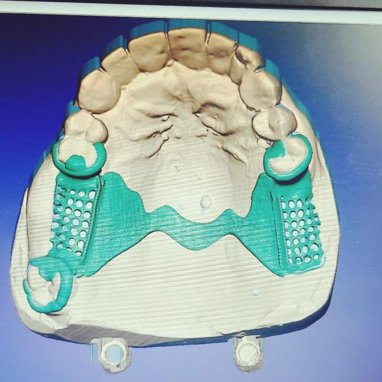 Dental laboratory materials & CAD/CAM restorations